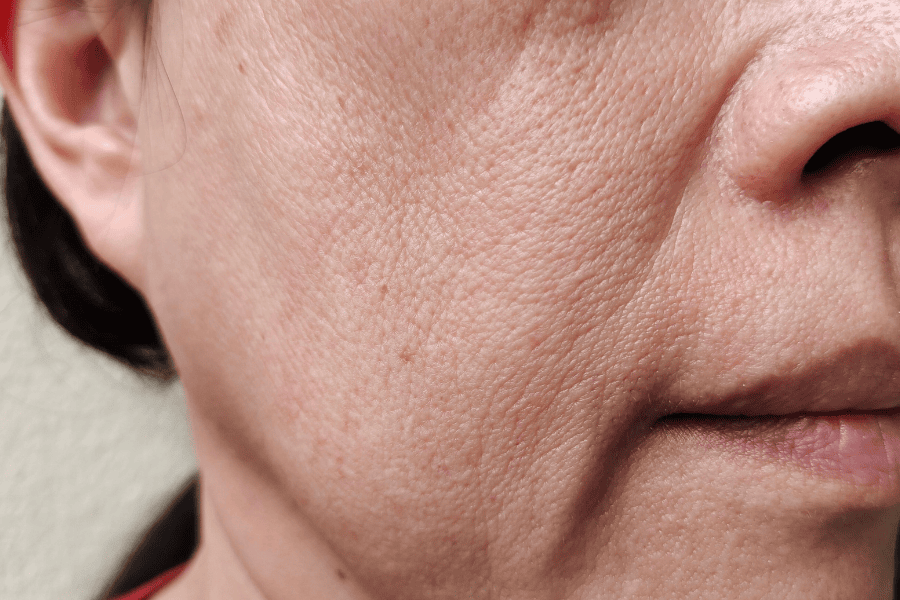 Rãnh râu rồng là nếp gấp biểu cảm hình thành từ vùng cánh mũi kéo dài xuống hai bên khóe miệng