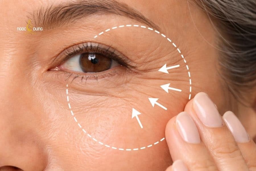 Nếp nhăn dưới mắt và bọng mắt là dấu hiệu khỏi điểm cho tình trạng da bị chảy xệ