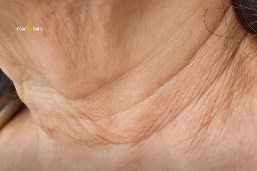 Nếp nhăn ở cổ cũng là biểu hiện của lão hóa da sớm