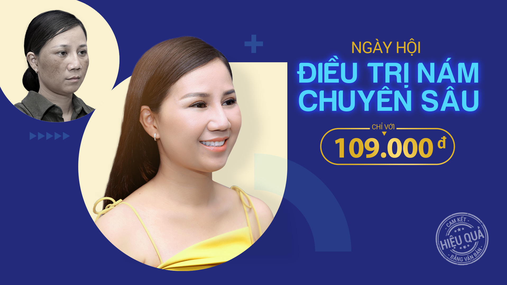 trị nám chuyên sâu