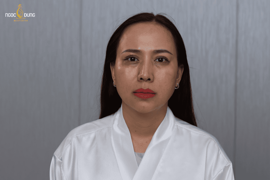 Các yếu tố quan trọng ảnh hưởng tới chi phí trị thâm mắt 