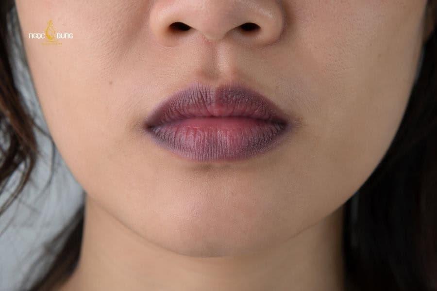 Môi thâm do dùng son kém chất lượng