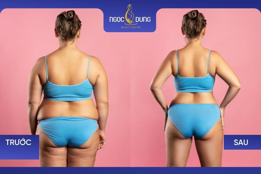 Kết quả giảm mỡ lưng tại TMV Ngọc Dung