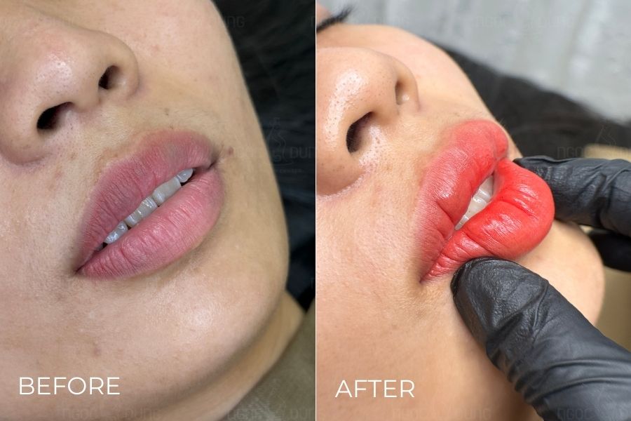 Đôi môi căng hồng rạng rỡ sau khi phun môi tại TMV Ngọc Dung