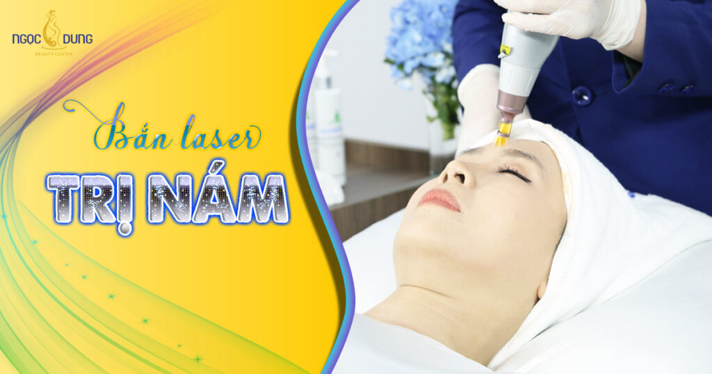 Bắn laser trị nám