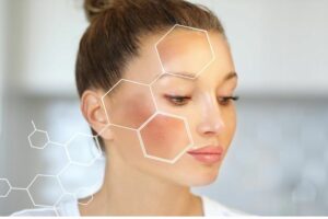 Chấm tàn nhang là gì