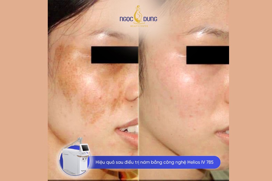 hình ảnh các loại nám hình ảnh các loại nám
