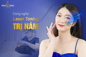 Laser Toning trị nám