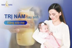 trị nám sau sinh bằng sữa mẹ