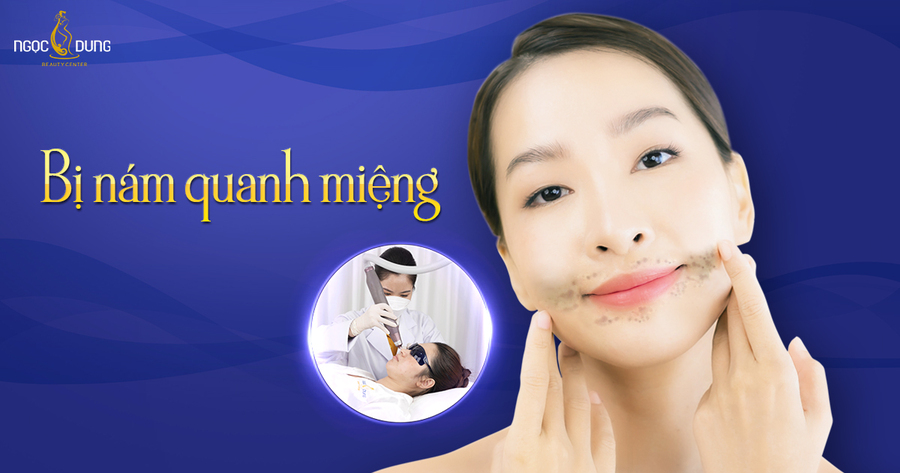 bị nám quanh miệng