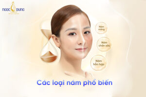 Phân biệt các loại nám và nguyên nhân hình thành, cách điều trị