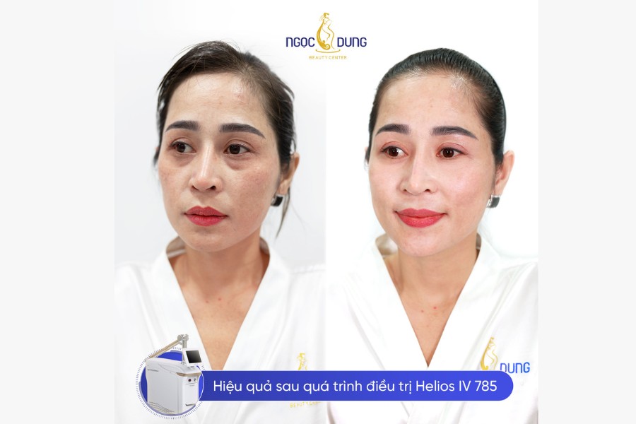 các loại nám và cách trị các loại nám và cách trị