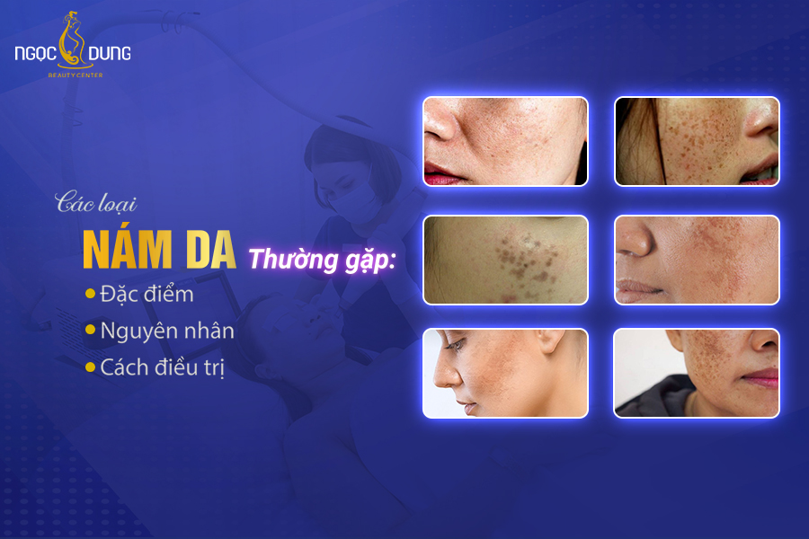 các loại nám các loại nám