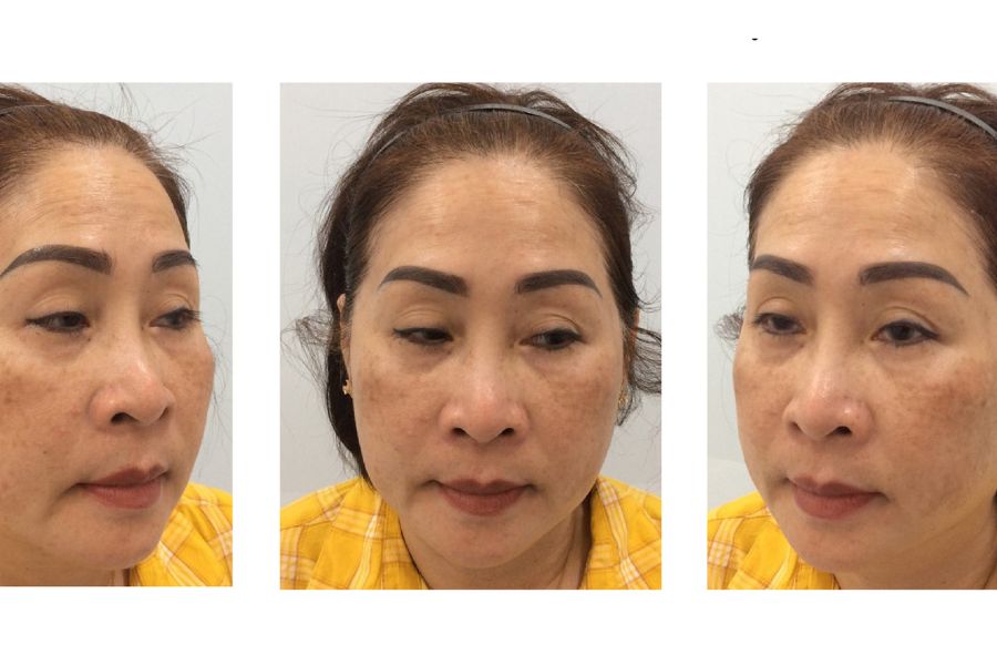 Nám nội tiết có tự hết không? Nguyên nhân và cách trị hiệu quả 19 chữa nám nội tiết tại TMV Ngọc Dung
