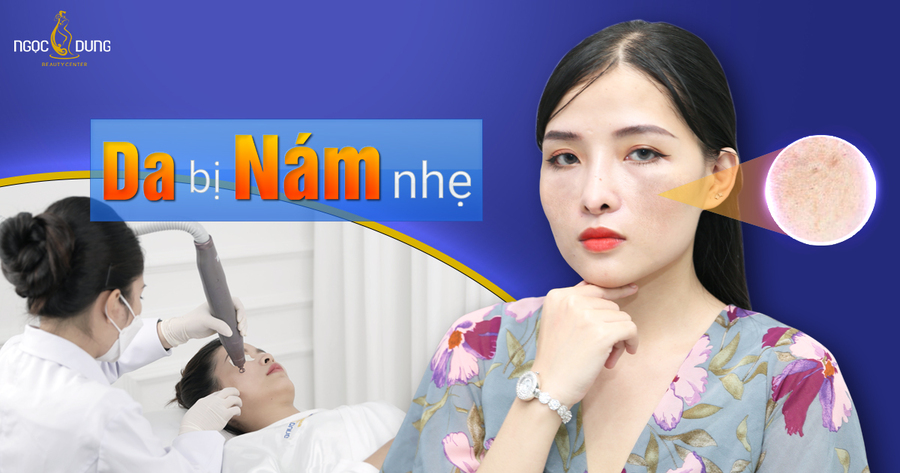 Da bị nám nhẹ