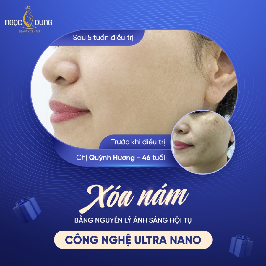 10 Năm trị nám gò má không hiệu quả, chị Quỳnh Hương đã tìm lại được làn da sáng mịn nhờ công nghệ Ultra Nano