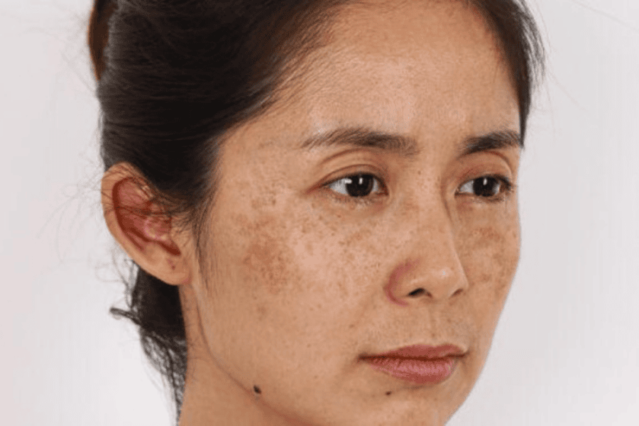 Sự kết hợp giữa thay đổi nội tiết trong giai đoạn tiền mãn kinh và mãn kinh làm tăng khả năng xuất hiện nám da