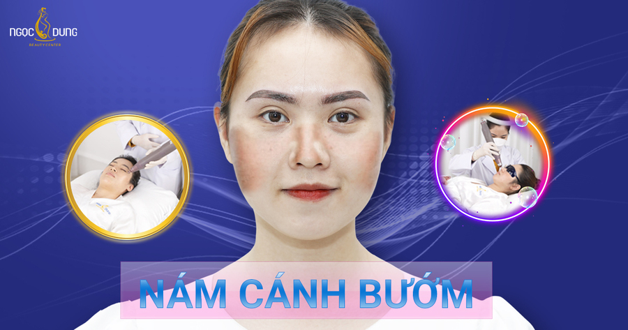 nám cánh bướm