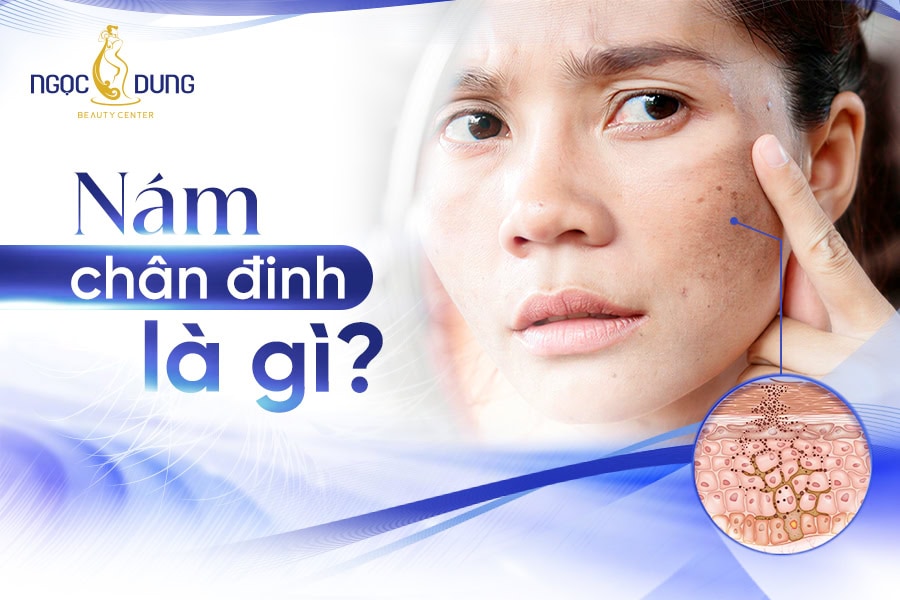 Nám chân đinh là gì?