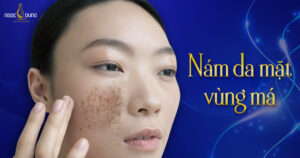 nám da mặt vùng má
