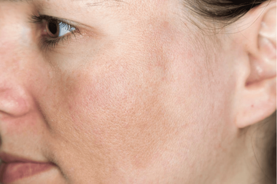 Nám da nhẹ thường khởi phát âm thầm và dễ bị nhầm lẫn với tàn nhang hoặc sạm da thông thường