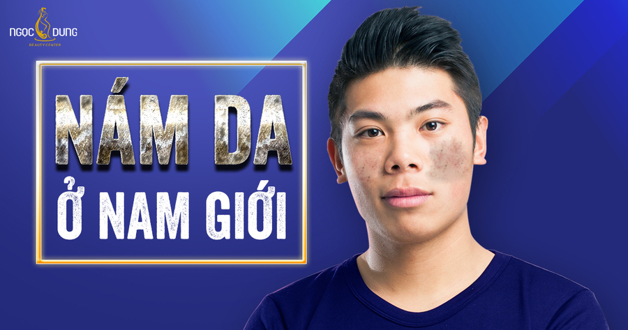 Nám da ở nam giới Nám da ở nam giới