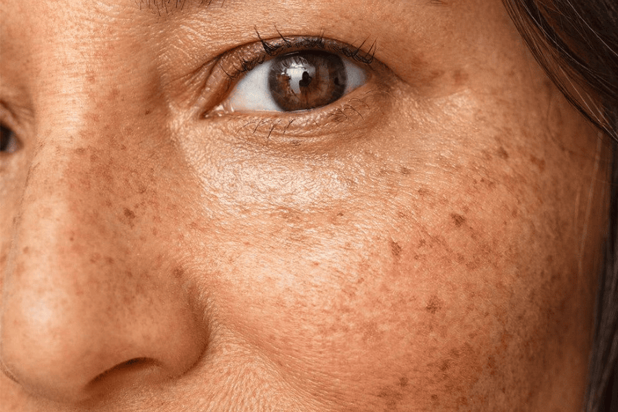 Các loại nám da phổ biến: Đặc điểm, nguyên nhân và cách điều trị hiệu quả 2 Nám da thường biểu hiện bằng mảng tăng sắc tố nâu, dễ tăng đậm sau nắng và thay đổi nội tiết.