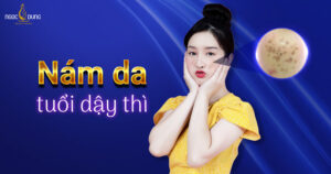 nám da tuổi dậy thì