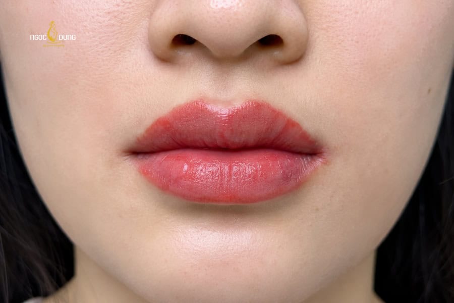 Phun môi với kỹ thuật lỗi thời cũng làm môi không lên màu sau thủ thuật