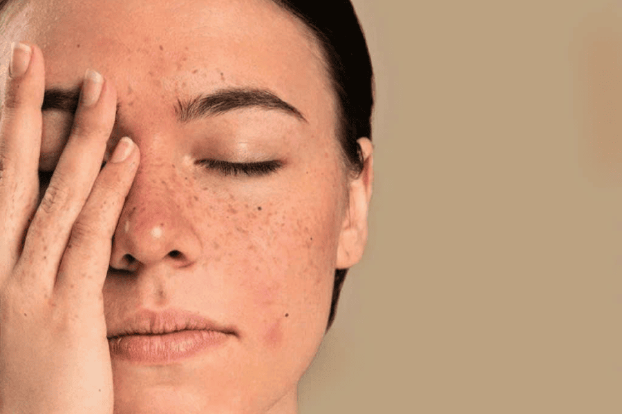 Các loại nám da phổ biến: Đặc điểm, nguyên nhân và cách điều trị hiệu quả 9 Biến động nội tiết tố kích thích nám da bùng phát mạnh mẽ từ sâu bên trong.