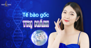 tế bào gốc trị nám
