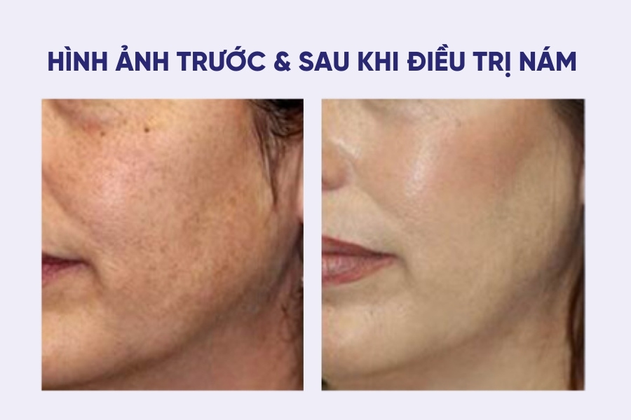 Tình trạng nám da của khách hàng đã có sự cải thiện rõ rệt sau liệu trình trị nám tại Ngọc Dung Beauty