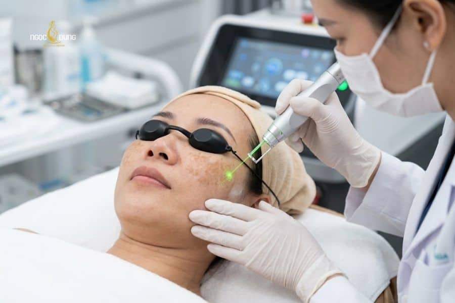 Bác sĩ tiến hành đi laser đã điều chỉnh thông số phù hợp lên vùng da nám cánh bướm