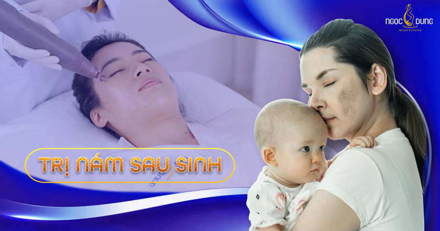 trị nám sau sinh trị nám sau sinh
