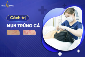 16 Cách trị mụn trứng cá an toàn, lành tính, dễ thực hiện