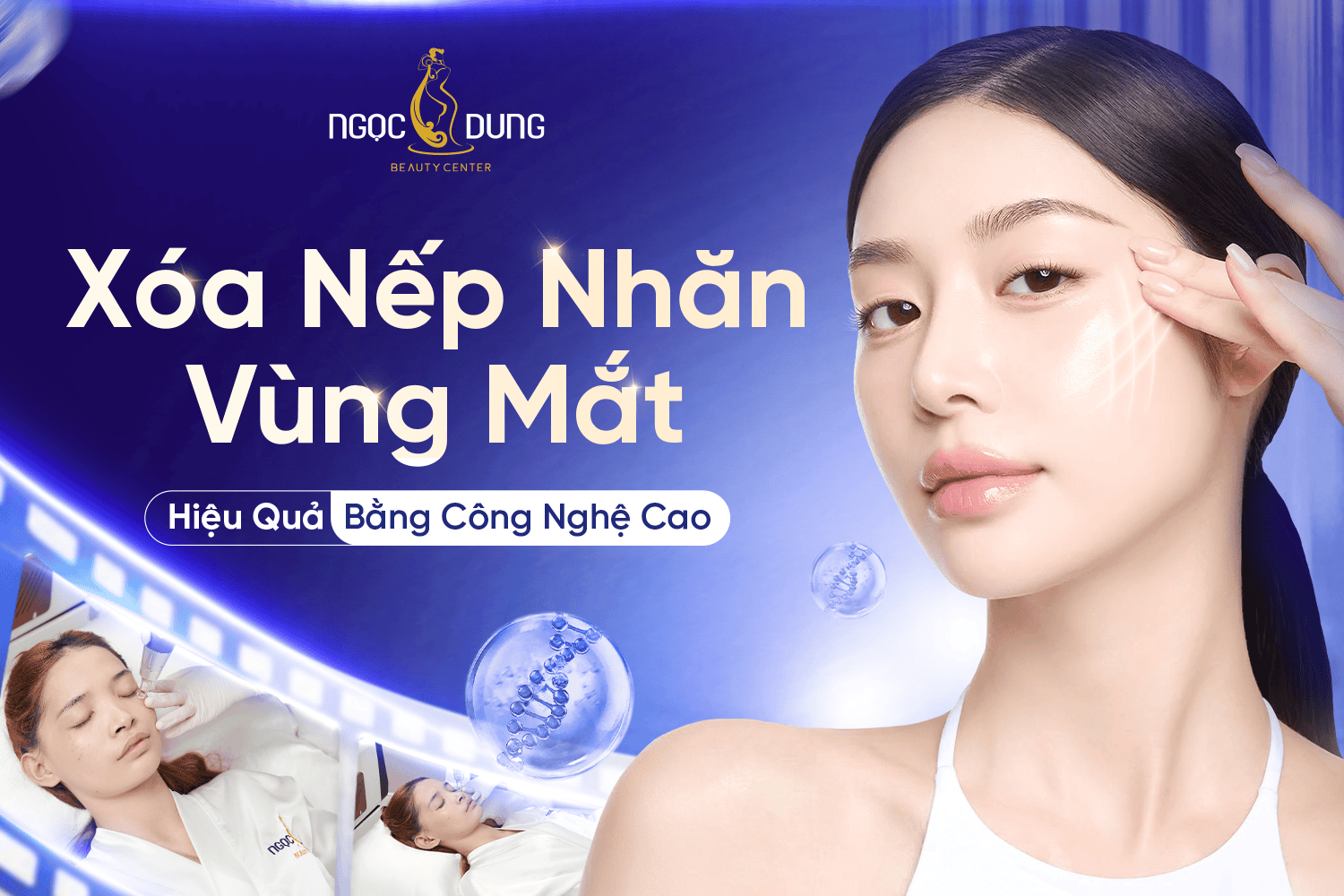 Xóa nếp nhăn vùng mắt bằng công nghệ cao