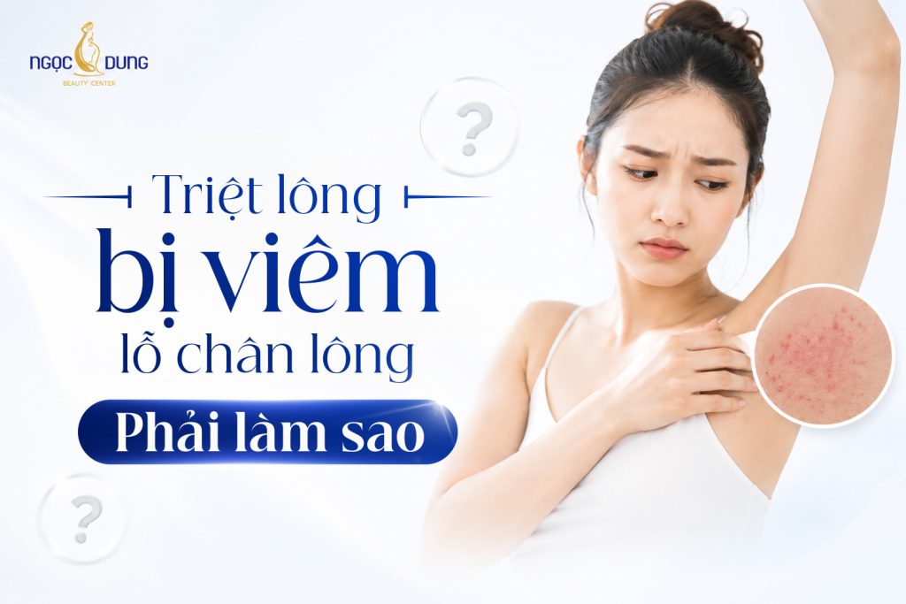 Triệt lông bị viêm lỗ chân lông: Nguyên nhân và cách trị