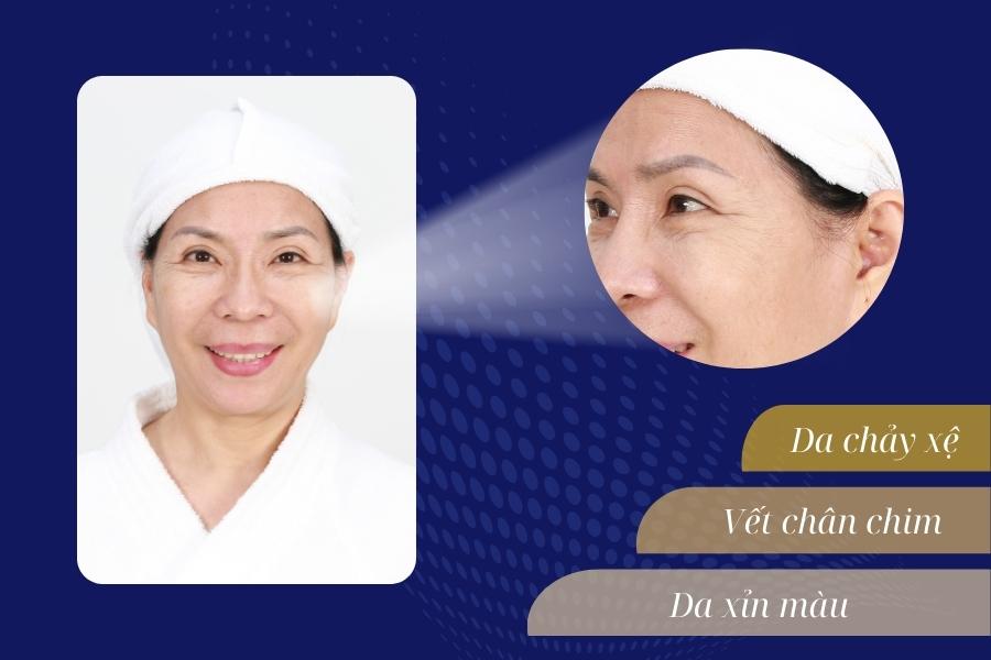 Trẻ hóa da là gì? Có tốt không? Phương pháp trẻ hóa tốt nhất 17 Hình ảnh da khách hàng trước khi làm trẻ hóa da