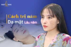 cách trị nám da mặt lâu năm