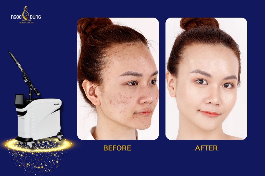 Hình ảnh khách hàng trước và sau khi điều trị thâm mụn tại Ngọc Dung