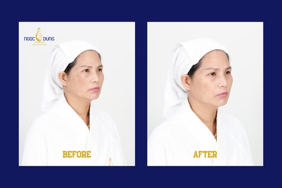 Bí quyết trị tàn nhang hiệu quả giúp chị em lấy lại vẻ đẹp tự tin 14 Kết quả điều trị tàn nhang bằng công nghệ cao