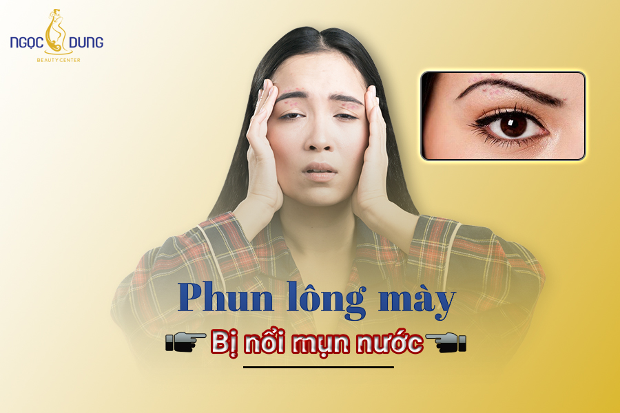 Phun lông mày bị nổi mụn nước