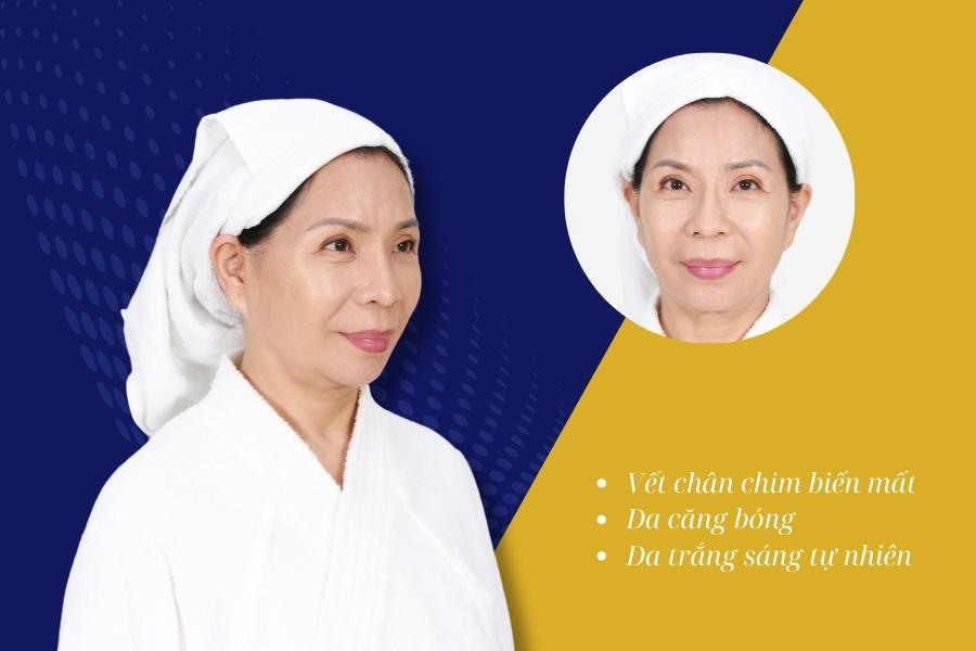 Trẻ hóa da là gì? Có tốt không? Phương pháp trẻ hóa tốt nhất 18 Kết quả sau khi trẻ hóa da bằng công nghệ cao tại Ngọc Dung