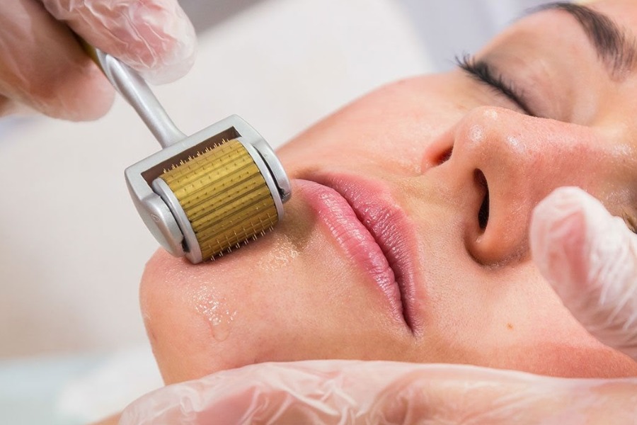 Xóa sẹo lõm trên mặt lâu năm bằng cách lăn kim Xóa sẹo lõm trên mặt lâu năm bằng cách lăn kim