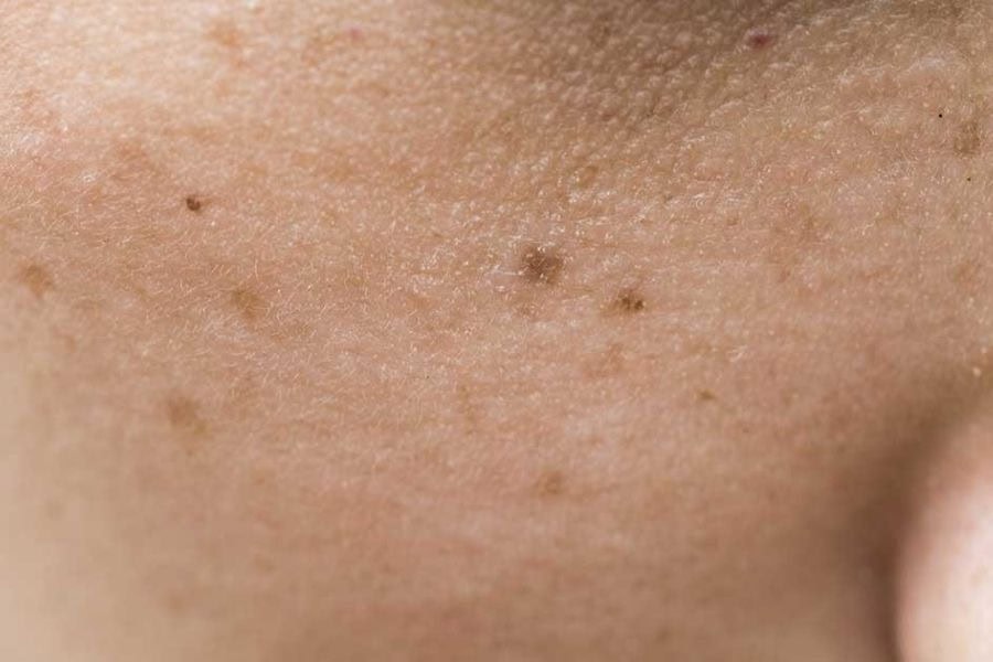 Da sẽ dễ bị sẹo thâm nếu tẩy nốt ruồi tại nhà không đúng cách