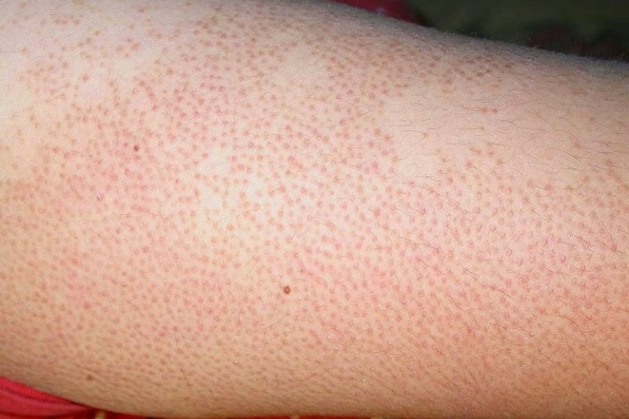 Sau khi triệt lông bị viêm lỗ chân lông​ có thể nhận biết sớm qua những thay đổi bất thường trên bề mặt da