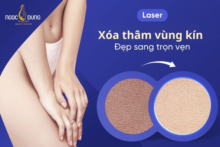 Ngọc Dung mang đến giải pháp làm bím đẹp hết thâm an toàn bằng Laser