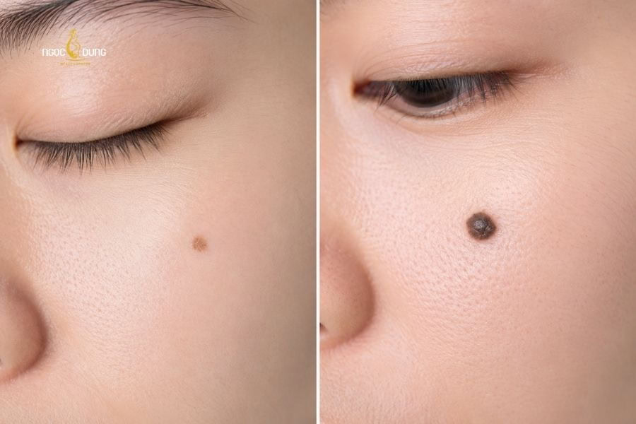 Tẩy nốt ruồi an toàn bằng laser không sẹo tại Ngọc Dung 5 Các dạng nốt ruồi thường gặp
