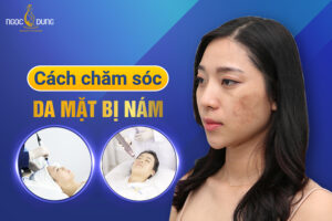 Chăm sóc da sau khi điều trị là phương pháp tốt nhất ngăn ngừa tái nám