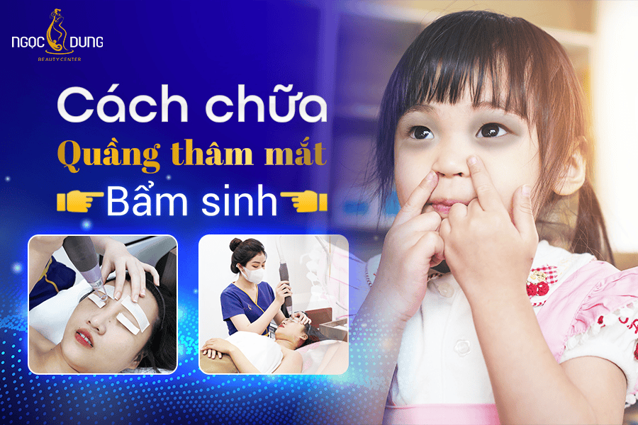 Cách chữa quầng thâm mắt bẩm sinh dứt điểm